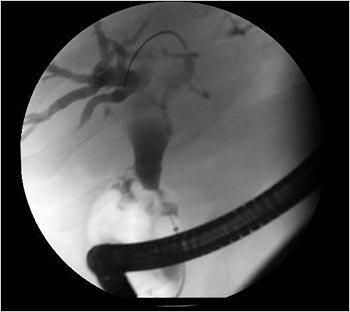 ERCP Image 1