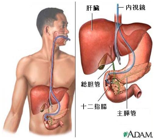 Read more about the article 内視鏡的逆行性胆管膵管造影（ERCP)